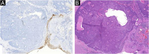 Poroma écrino pigmentado. (A) Imunomarcação negativa para o antígeno carcinoembrionário (CEA) policlonal. (B) Imagem comparativa da neoplasia (Hematoxilina & eosina, 10×).