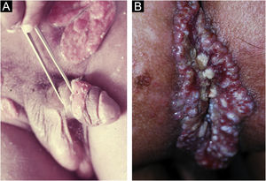 (a) Donovanose: úlcera vegetante com fundo vermelho brilhante (borda elevada e/ou evertida). (b) Crescimento linear pelas dobras cutâneas, podendo atingir grandes dimensões. Fotos: Prof. Sinésio Talhari.