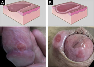 (a) Cancro duro recente erosado, arredondado com borda em rampa suave. (b) Cancro duro com evidente infiltração. Representação gráfica adaptada de wikicommons_org (domínio público).