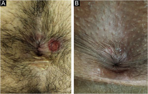 (a) Cancro duro perianal de configuração típica. A coloração desta lesão é frequentemente comparada à de presunto cru. (b) Quando próxima ao ânus, pode apresentar forma irregular, acompanhando a disposição das pregas anais.