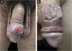 (a) Com diâmetro superior a 2cm, são denominados cancros gigantes. (b) Quando destrutivas, são denominados cancros fagedênicos, frequentemente associados à superinfeção por bactérias em associação.