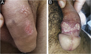 (a) Herpes‐simples em surtos subentrantes: vesículas agrupadas sobre base eritematosa e úlcera superficial em reparação com borda policíclica. (b) Úlcera mais profunda apresentando fundo fibrinoide e borda subminada.