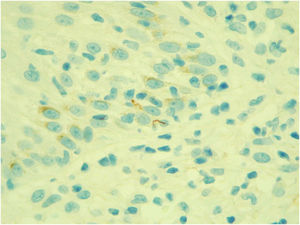 Exame imuno‐histoquímico positivo para Treponema pallidum (630×).