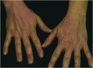 Erupção eritematosa localizada em área de fotoexposição na região dorsal das mãos.