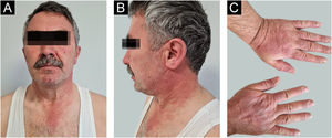Manchas e placas eritematosas, bem definidas em áreas fotoexpostas do pescoço e da face (A–B), juntamente com manchas eritematovioláceas nas mãos (C).
