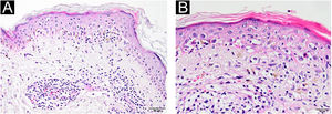(A) Degeneração vacuolar na camada basal da epiderme e inflamação perivascular em “manguito” na derme superior (Hematoxilina & eosina, 200×). (B) Ceratinócitos e linfócitos necróticos na epiderme (necrose de células satélites), incontinência de melanina e eritrócitos extravasados (Hematoxilina & eosina, 400×).