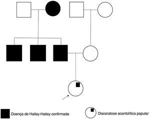 Pedigree familiar mostrando os parentes da paciente com diagnóstico confirmado de DHH.