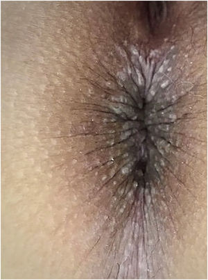 Múltiplas pápulas ceratóticas branco‐acinzentadas na região perianal e períneo.