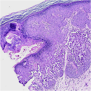 Histopatologia evidenciando área de disceratose, acantólise e fendas suprabasais (Hematoxilina & eosina, 20×).