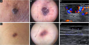 Aparência clínica, dermatoscópica (dispositivo portátil Dermlite DL200 Hybrid, 3Gen, San Juan Capistrano, CA) e ultrassonográfica (transdutor de matriz linear multifrequência ARIETTA 850 15,0‐18,0MHz, Hitachi Medical Systems®, Zug, Suíça) das lesões estudadas dos pacientes 1 (A ‐C) e 2 (D‐F).