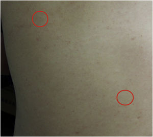 Características clínicas na apresentação. Presença de dois nódulos subcutâneos do tamanho de uma moeda no dorso (círculos vermelhos); a pele sobrejacente aos nódulos era normal.