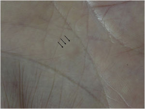 Nódulo firme de cor da pele na região palmar (setas).