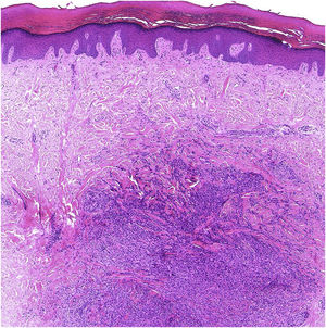Histopatologia mostrando proliferação de fibroblastos na derme (hematoxilina e eosina × 100).