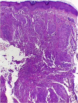Histiocitose de Hashimoto‐Pritzker – análise histopatológica: infiltração dermo‐hipodérmica densa de células histiocitoides (Hematoxilina & eosina, 40×).