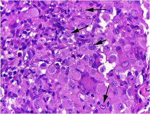 Histiocitose de Hashimoto‐Pritzker ‐ grande ampliação revela células com citoplasma eosinofílico abundante e núcleos claros ovoides ou em forma de rim (setas) (Hematoxilina & eosina, 400×).