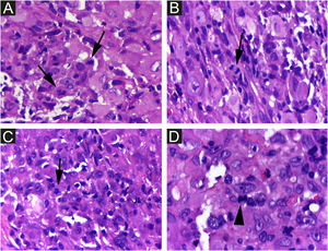Histiocitose de Hashimoto‐Pritzker. Há várias mitoses (setas). Hematoxilina & eosina, 400×.