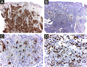 Histiocitose de Hashimoto‐Pritzker. As células apresentam forte imunorreatividade com CD1a (A) e menos com CD207 (B e C). (D), Alto índice proliferativo com Ki67 (62%). Ampliação original 40× (A, B); 400× (C, D).