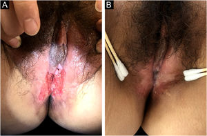 Imagens clínicas. (a) Aparência da úlcera antes do tratamento. (b) Úlcera cicatrizada após o tratamento.