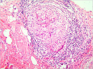 Granuloma com necrose caseosa e infiltrado linfocítico (Hematoxilina & eosina, 400×).