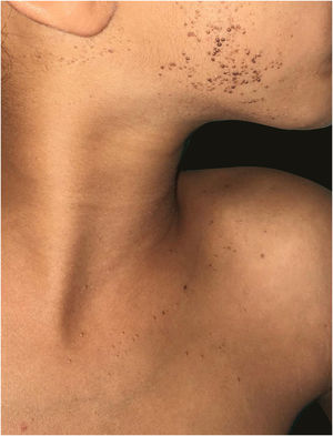 Lesões papulares hiperpigmentadas, algumas verrucosas, lineares e unilaterais, na face e região cervical/tronco direitas.