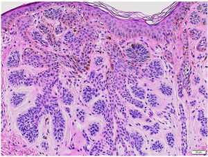 Proliferações de células epitelioides basaloides com padrão cordonal e ilhotas em disposição radial (Hematoxilina & eosina, 200×).