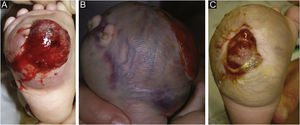 (A), Massa tumoral ulcerada e sangrante. (B), Após 13 semanas, aumento importante do tamanho (antes da quimioterapia). (C), Redução do tumor e da úlcera após quimioterapia adjuvante e antes da amputação.