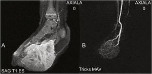(A), Ressonância magnética identificando massa expansiva com realce difuso do contraste. (B), Angiografia por ressonância magnética mostrando lesão expansiva sustentada por estruturas vasculares. Não há evidência de fístulas arteriovenosas ou nidus.