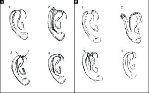 (A), Retalho condrocutâneo clássico. (A.1), Defeito helicoidal, linhas tracejadas indicam incisões na pele e cartilagem. (A.2), Incisão na face anterior da orelha, incluindo cartilagem, sem transfixar a pele retroauricular. (A.3), Movimento de avanço e sutura da cartilagem. (A.4), Sutura da pele. (B), Retalho condrocutâneo de espessura total. (B.1), Defeito helicoidal. (B.2), Incisão na face anterior e posterior da orelha, incluindo cartilagem, transfixando pele retroauricular. (B.3), Movimento de avanço. (B.4), Sutura por planos.