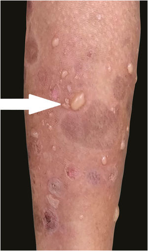 Imagem clínica de lesão tipo penfigoide bolhoso sobre pele normal e inflamada (seta).