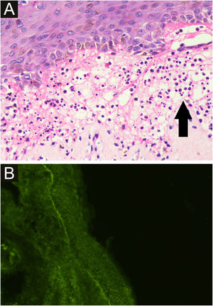 A ‐ Microscopia óptica de lesão bolhosa mostrando clivagem subepidérmica com neutrófilos polimorfonucleares (seta) e poucos eosinófilos (Hematoxilina & eosina, 400×). B ‐ Imunofluorescência direta mostrando depósito linear de C3 na junção dermoepidérmica, enquanto IgA, IgG, IgM, e fibrinogênio foram não reativos.