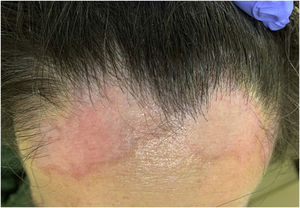 Manchas róseas com borda eritematosa, na linha de implantação frontal dos cabelos.