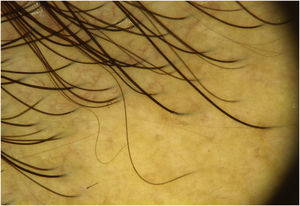 Dermatoscopia da pele não afetada do couro cabeludo, na linha fronto‐temporal dos cabelos. Não há evidência de pontos amarelos.