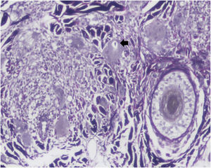 Fibras elásticas no citoplasma de uma célula gigante multinucleada (seta preta; Verhoeff‐Van Gieson, 100×).