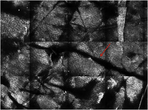 Microscopia confocal de reflectância do estrato córneo. Células poligonais planas e anucleadas representando os corneócitos, estruturas lineares escuras representando os dermatóglifos (seta vermelha).