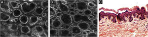 Microscopia confocal de reflectância da junção dermoepidérmica. (A e B) Papilas bem demarcadas formadas por anéis bem demarcados ao redor de centro escuro representando os queratinócitos pigmentados e/ou melanócitos basais circundando a papila dérmica escura. O padrão anular define papilas bem demarcadas. (C) Histologicamente, o padrão anular representa cones interpapilares alongados, com um número aumentado de melanócitos isolados na camada basal.