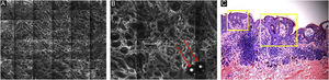 Microscopia confocal de reflectância da junção dermoepidérmica. (A) Padrão em malha, caracterizado por cordões hiperrrefletivos alongados, correspondendo ao espessamento juncional. (B) Aumento maior mostrando cordões alongados se interligando; estruturas brancas redondas representam cistos tipo milia (setas vermelhas). (C) Histopatologia mostrando o alargamento do espaço interpapilar, formado por melanócitos agregados, com ninhos predominantemente pequenos e interconectados na extremidade dos cones interpapilares.