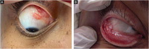 Formas clínicas da esporotricose humana. (A), Mucosa – lesão na conjuntiva bulbar. (B), Mucosa – lesão na conjuntiva tarsal, com pus.