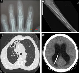 Imagens radiológicas na esporotricose humana. (A), Forma osteoarticular – reabsorção da falange distal do dedo mínimo causada por mordedura de gato (radiografia simples). (B), Forma sistêmica com manifestação osteoarticular – lesões osteolíticas na medula da tíbia por disseminação hematogênica em paciente com esporotricose sistêmica e AIDS (radiografia simples). (C), Pulmonar – cavidade no lobo superior do pulmão direito e extensa opacidade com aspecto fibrorretrátil (tomografia computadorizada). (D), Neuroesporotricose – meningite em paciente com esporotricose sistêmica e AIDS. Aumento das dimensões do sistema ventricular, principalmente na região supratentorial (hidrocefalia tetraventricular), cateter de derivação ventriculoperitoneal (tomografia computadorizada).