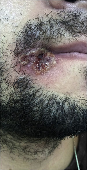 Varíola dos macacos. Pústulas confluentes esboçando umbilicação central, e área úlcero‐necrótica central, localizada no ângulo labial direito.