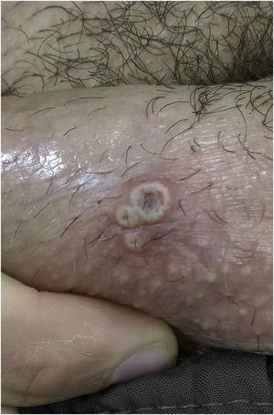 Varíola dos macacos. Três pústulas com umbilicação central na haste do pênis.