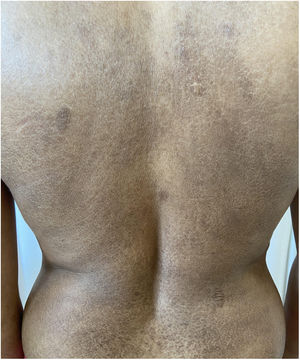 Placas hipercrômicas com descamação ictiosiforme no tronco posterior.