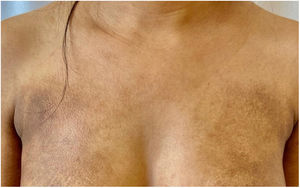 Placas hipercrômicas com descamação ictiosiforme no tronco anterior.