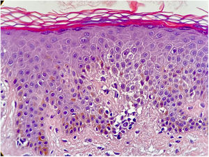 Hiperceratose ortoceratótica com hipogranulose e exocitose de linfócitos atípicos (Hematoxilina & eosina, 40×).
