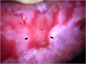A dermatoscopia da QCP mostra bordas bem demarcadas com área vermelho‐leitosa sem estrutura (asterisco), pequenas erosões (seta branca) e múltiplos vasos lineares aumentados na periferia, com distribuição radial (setas pretas); também é visto um pequeno foco de escamas brancas na face inferior da lesão.