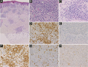 A histopatologia mostra infiltração de células inflamatórias principalmente na epiderme e ao redor de vasos sanguíneos e glândulas sudoríparas na derme (A). Na epiderme, as células inflamatórias são linfócitos (B). Ao redor dos vasos sanguíneos na derme, as células inflamatórias são linfócitos e eosinófilos (C) (Hematoxilina & eosina, ampliação original: A, 50×; B, 400×; C, 400×). A imuno‐histoquímica revelou elevada expressão de CD3 (D) e CD4 (F), e pouca expressão de CD20 (E), CD8 (G) e CD30 (H) nos linfócitos que infiltravam a epiderme (ampliação original: d–h, 400×).
