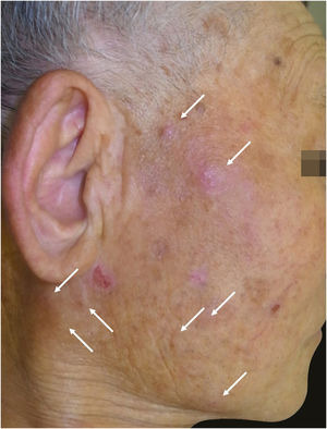 Nódulos avermelhados ou cor da pele na região facial direita (setas).