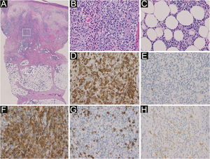 A histopatologia mostra infiltração acentuada de células inflamatórias principalmente ao redor dos vasos sanguíneos e glândulas sudoríparas na derme e tecido subcutâneo (A). O maior aumento revela que na derme (B) e no tecido subcutâneo (C) as células inflamatórias são linfócitos e eosinófilos não neoplásicos (Hematoxilina & eosina, ampliação original: A, 50×; B, 400×; C, 400×). A imuno‐histoquímica revela elevada expressão de CD3 (D) e CD4 (F), e pouca expressão de CD20 (E), CD8 (G) e CD30 (H) nos linfócitos infiltrantes (ampliação original: d–h, 400×).