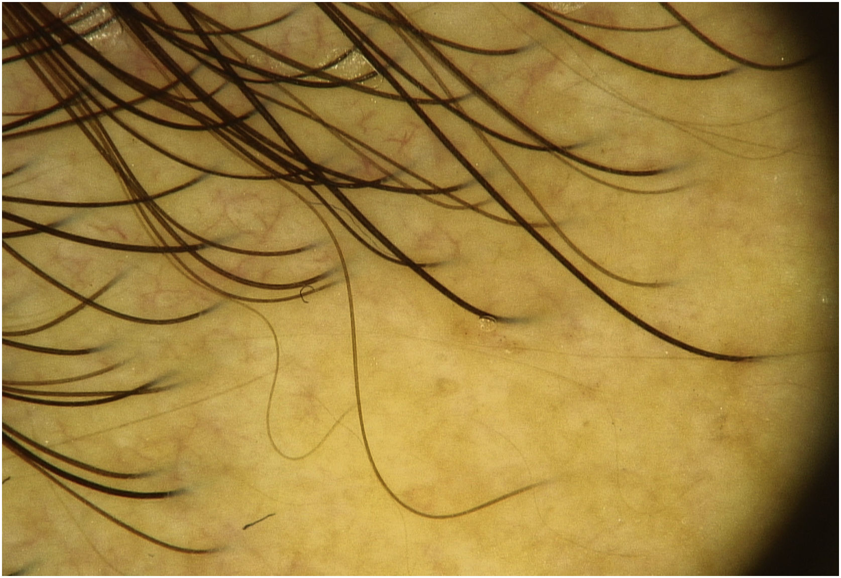 Acuminada Derma Dermatoscopia de granuloma anular elastolítico de células gigantes ...