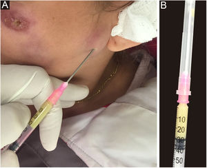 Coleta de material. (A), Exsudato purulento, colhido por punção de abscesso cutâneo, na esporotricose humana. (B), Material (pus) a ser enviado para exame micológico.