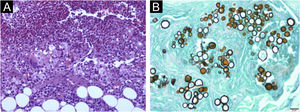 (A) Processo inflamatório crônico granulomatoso, com grande quantidade de neutrófilos e células gigantes multinucleadas com estruturas arredondadas no citoplasma (Hematoxilina & eosina, 100×). (B) Estruturas esféricas coradas em castanho com gemulação múltipla em “roda de leme” e “orelha de Mickey mouse” (Grocott, 400×).